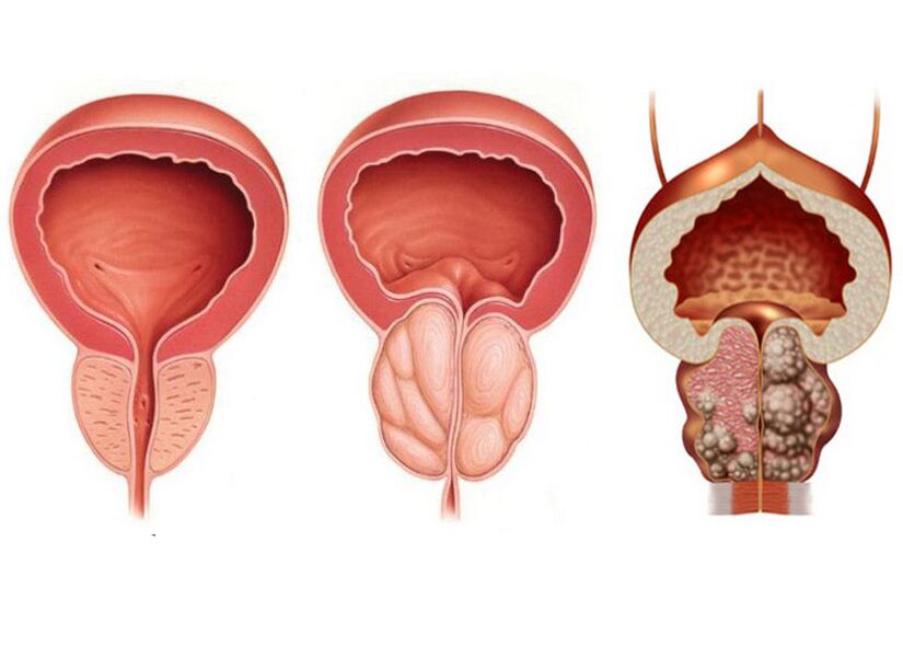 Étapes de la prostatite et la nécessité d'utiliser complètement la prostavit